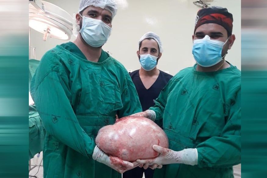 Tumor de quase 20 quilos é retirado do ovário de paciente em Cruzeiro do Sul — (Foto: Reprodução/Arquivo pessoal).