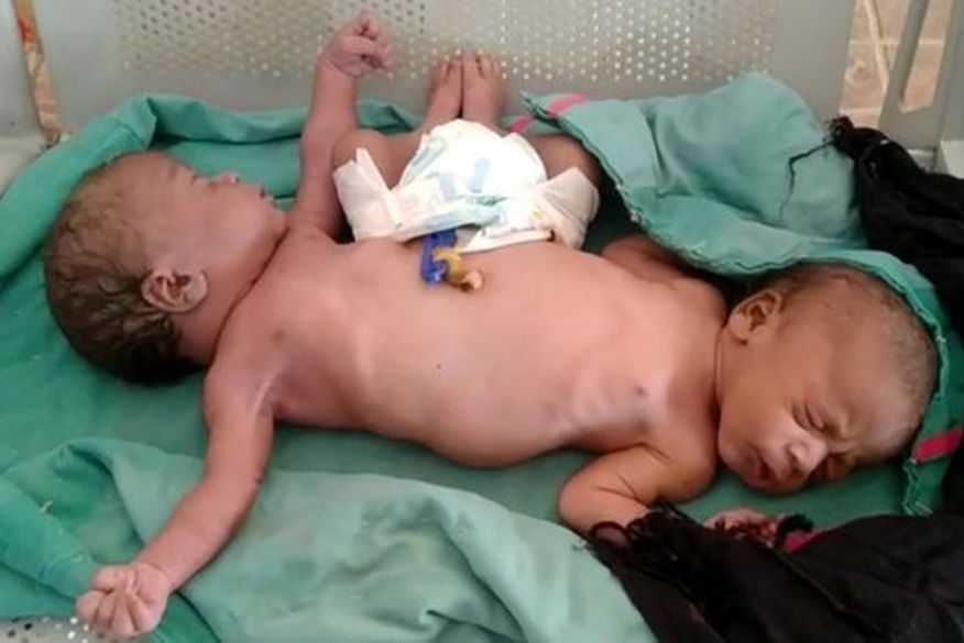 Gêmeos siameses se desenvolvem a partir de um único óvulo fertilizado e, portanto, são sempre idênticos e do mesmo sexo. (Foto: Reprodução).