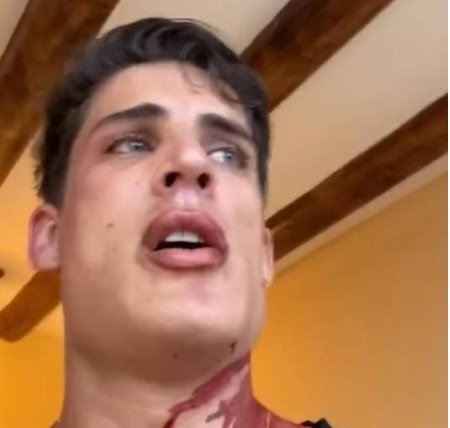 Tiago mostrou o rosto com machucados, a mandíbula e a boca inchadas, e bastante sangue na região da nuca. (Foto: Reprodução).
